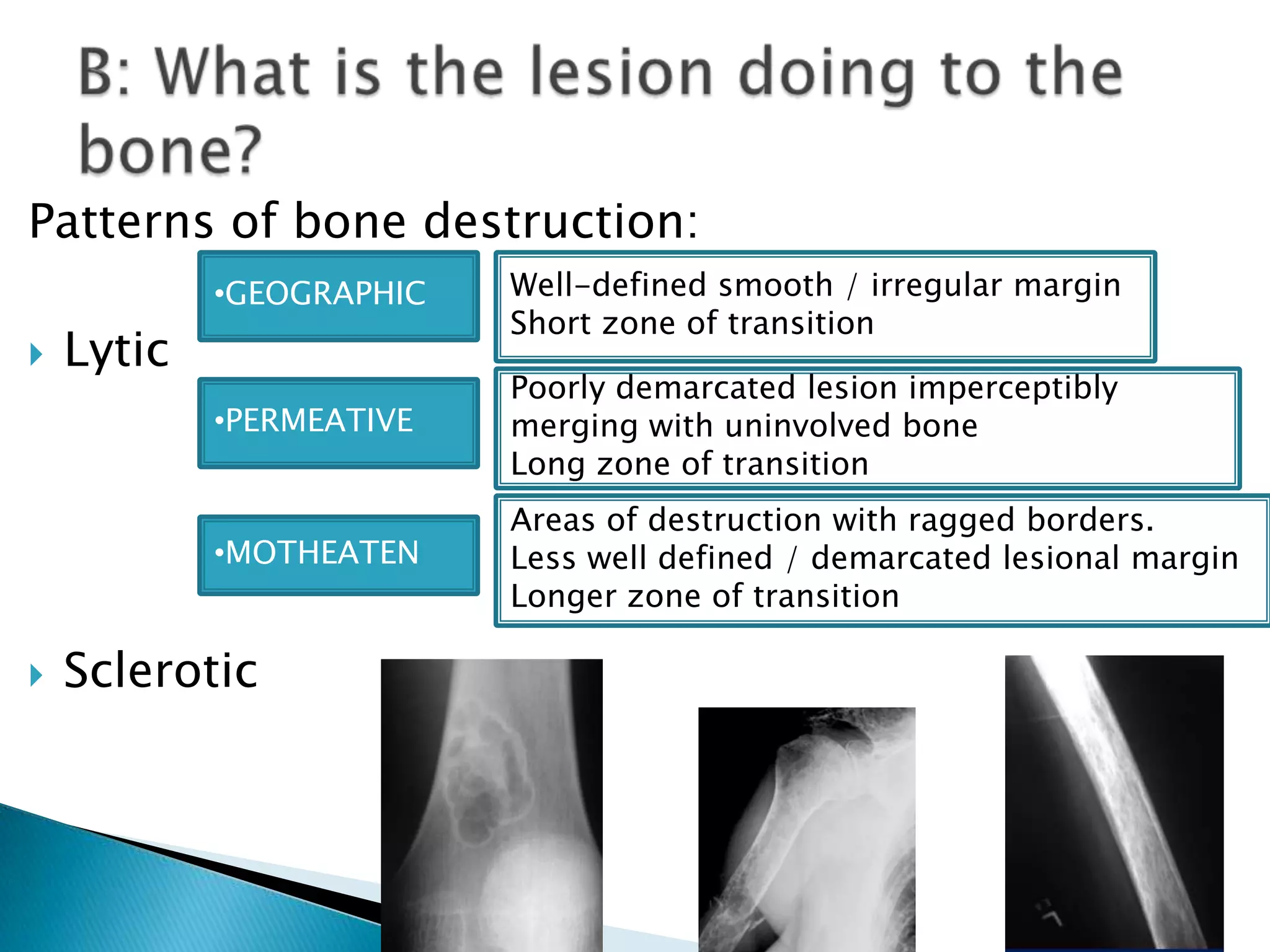 Patterns of bone destruction:
            •GEOGRAPHIC   Well-defined smooth / irregular margin
                          Short zone of transition
   Lytic
                          Poorly demarcated lesion imperceptibly
            •PERMEATIVE   merging with uninvolved bone
                          Long zone of transition
                          Areas of destruction with ragged borders.
            •MOTHEATEN    Less well defined / demarcated lesional margin
                          Longer zone of transition

   Sclerotic
 