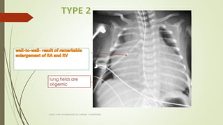 CHEST X RAY IN DIAGNOSIS OF CARDIAC CONDITIONS
 