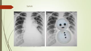 TAPVR
CHEST X RAY IN DIAGNOSIS OF CARDIAC CONDITIONS
 