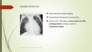 DOUBLE OUTLET RV
 Generalized cardiomegaly
 increased pulmonary vascularity.
 aorta and PA have a more side-to-side
con...