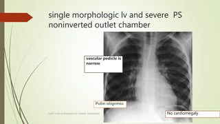 single morphologic lv and severe PS
noninverted outlet chamber
CHEST X RAY IN DIAGNOSIS OF CARDIAC CONDITIONS No cardiomeg...
