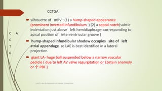 CCTGA
 silhouette of mRV : (1) a hump-shaped appearance
(prominent inverted infundibulum ) (2) a septal notch(subtle
inde...