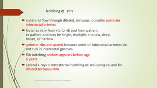 Notching of ribs
 collateral flow through dilated, tortuous, pulsatile posterior
intercostal arteries
 Notches vary from...