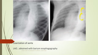 Coarctation of aorta
LAO , obtained with barium esophagography
CHEST X RAY IN DIAGNOSIS OF CARDIAC CONDITIONS
 