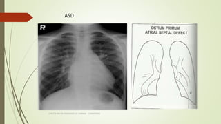 ASD
CHEST X RAY IN DIAGNOSIS OF CARDIAC CONDITIONS
 