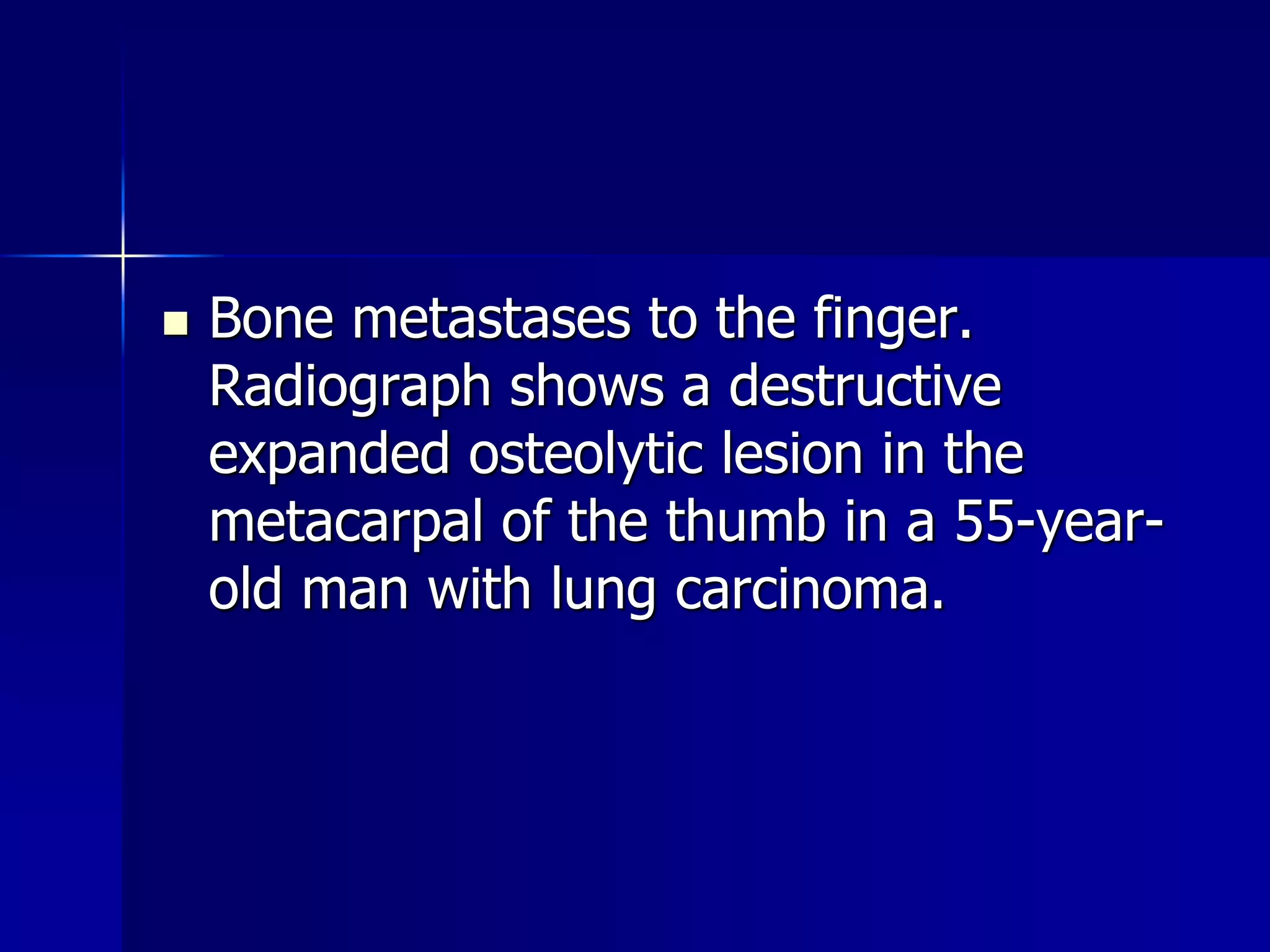  Bone metastases to the finger. 
Radiograph shows a destructive 
expanded osteolytic lesion in the 
metacarpal of the thumb in a 55-year-old 
man with lung carcinoma. 
 