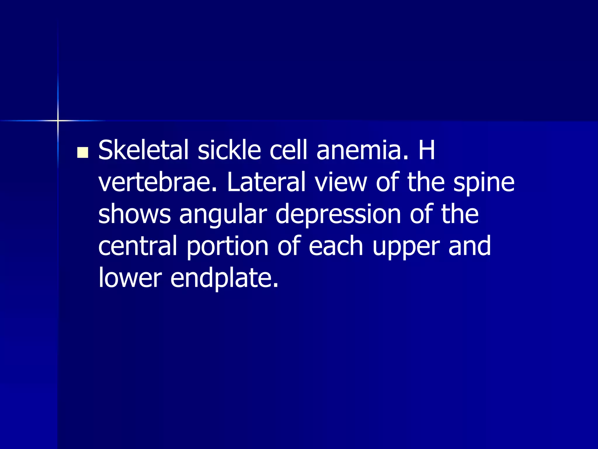 Skeletal sickle cell anemia. H 
vertebrae. Lateral view of the spine 
shows angular depression of the 
central portion of each upper and 
lower endplate. 
 