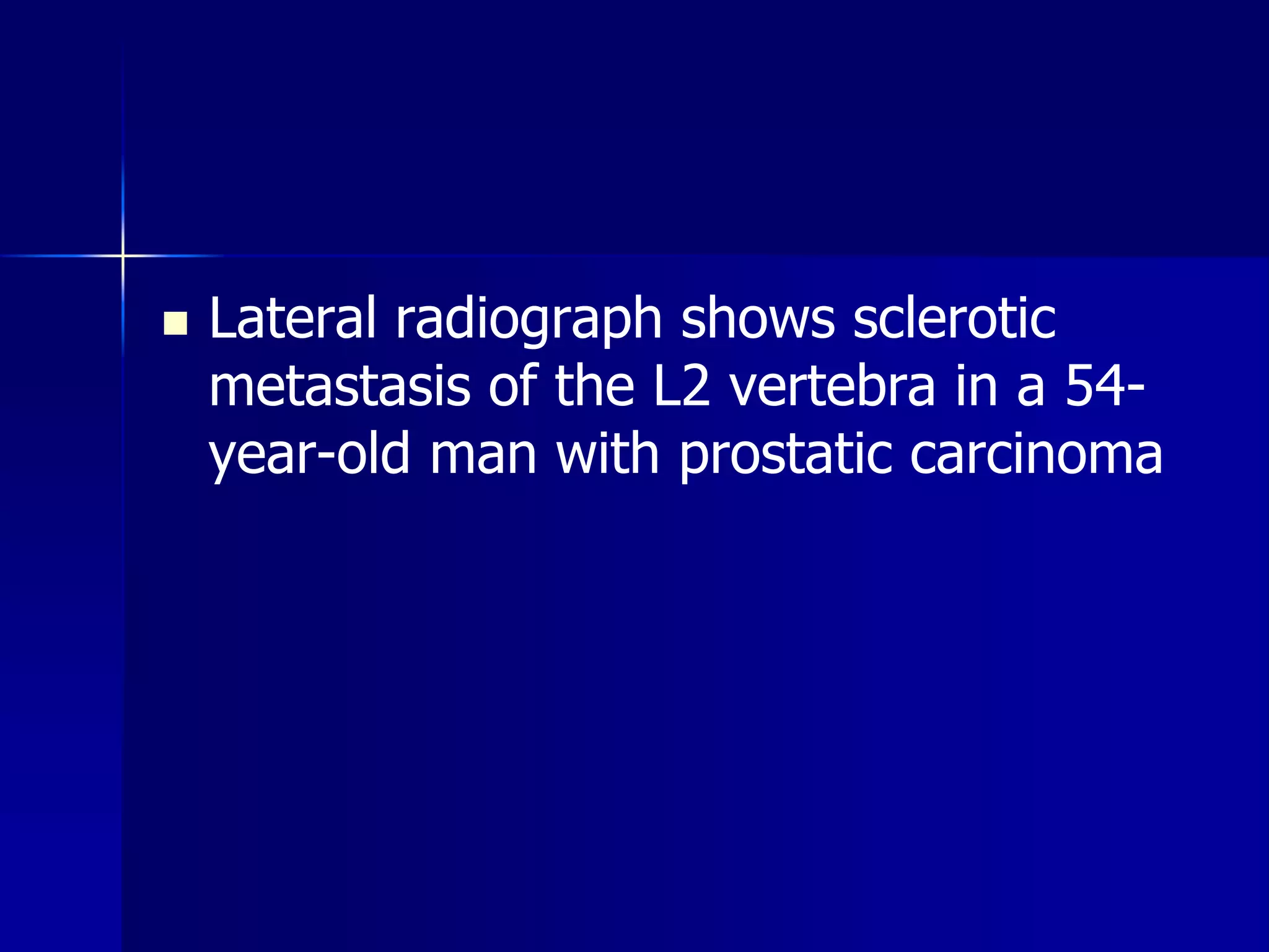  Lateral radiograph shows sclerotic 
metastasis of the L2 vertebra in a 54- 
year-old man with prostatic carcinoma 
 