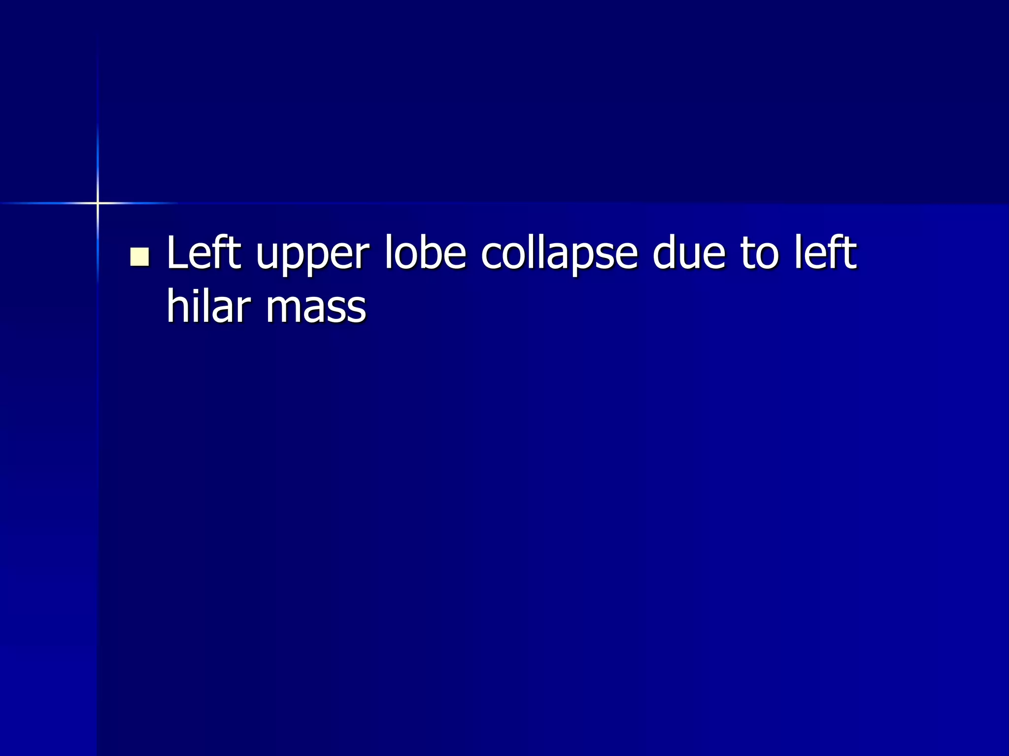  Left upper lobe collapse due to left 
hilar mass 
 