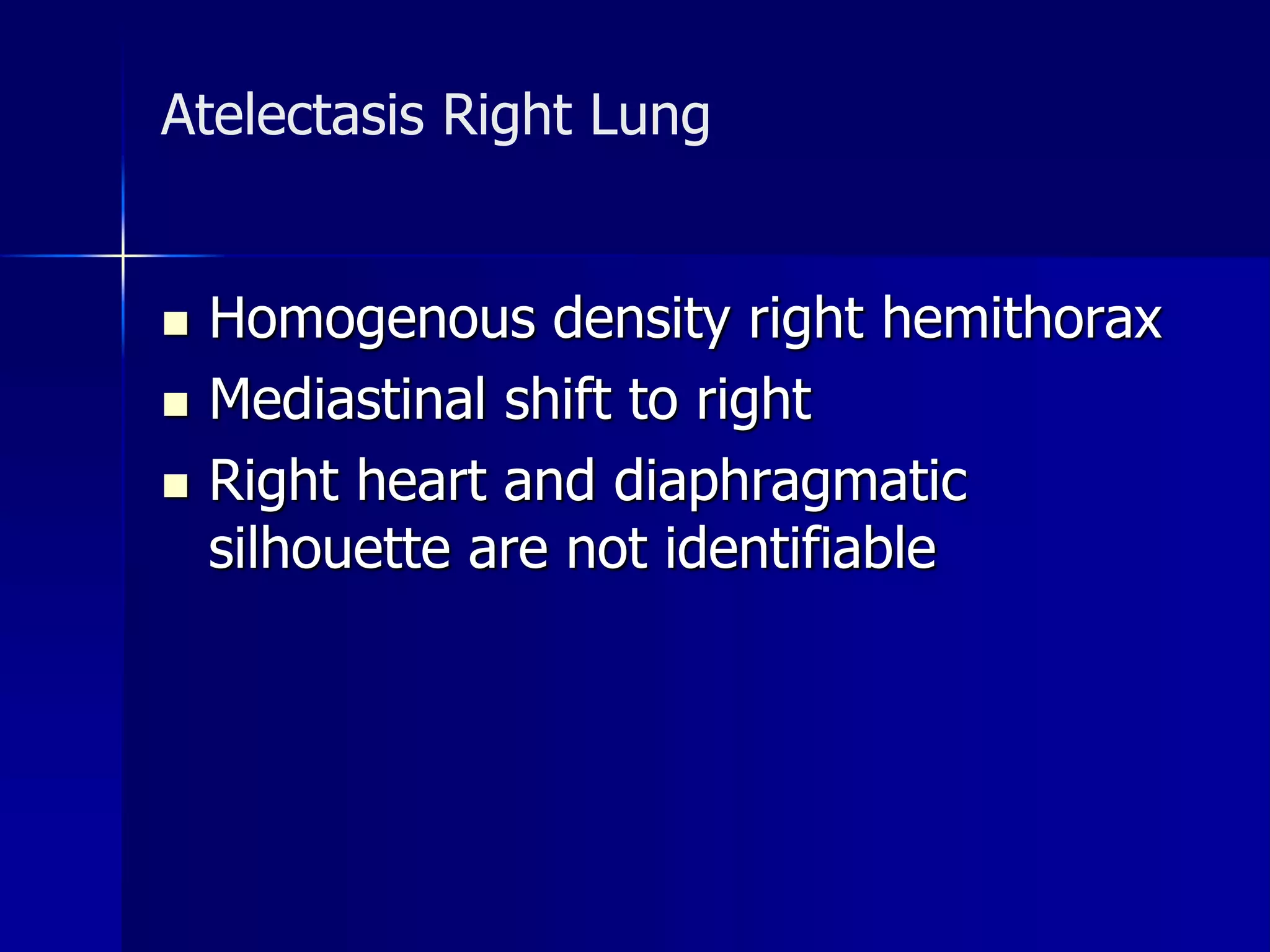 Atelectasis Right Lung 
 Homogenous density right hemithorax 
 Mediastinal shift to right 
 Right heart and diaphragmatic 
silhouette are not identifiable 
 