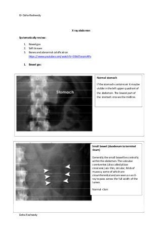 Dr Doha Rasheedy
Doha Rasheedy
X ray abdomen
Systematically review:
1. Bowel gas
2. Soft tissues
3. Bones and abnormal calcification
https://www.youtube.com/watch?v=SWd7onzmAPo
1. Bowel gas:
Normal stomach
If the stomach contains air it may be
visible in the left upper quadrant of
the abdomen. The lowest part of
the stomach crosses the midline.
Small bowel (duodenum to terminal
ileum)
Generally the small bowel lies centrally
within the abdomen. The valvulae
conniventes (also called plicae
circulares) are thin, circular, folds of
mucosa, some of which are
circumferential and are seen on an X-
ray to pass across the full width of the
lumen.
Normal <3cm
 