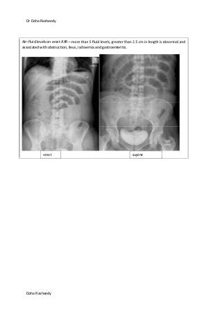 Dr Doha Rasheedy
Doha Rasheedy
Air–fluid levels on erect AXR—
associated with obstruction, ileus, ischaemia and gastroenteritis.
erect supine
 