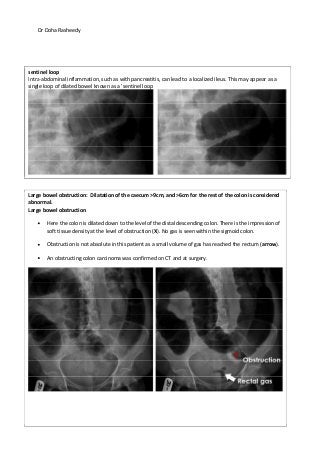 Dr Doha Rasheedy
Doha Rasheedy
sentinel loop
Intra-abdominal inflammation, such as with pancreatitis, can lead to a localized ileus. This may appear as a
single loop of dilated bowel known as a 'sentinel loop
Large bowel obstruction: Dilatation of the caecum >9cm, and >6cm for the rest of the colon is considered
abnormal.
Large bowel obstruction
Here the colon is dilated down to the level of the distal descending colon. There is the impression of
soft tissue density at the level of obstruction (X). No gas is seen within the sigmoid colon.
Obstruction is not absolute in this patient as a small volume of gas has reached the rectum (arrow).
An obstructing colon carcinoma was confirmed on CT and at surgery.
 