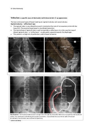 Dr Doha Rasheedy
Doha Rasheedy
Volvulus is a specific cause of obstruction with characteristic X-ray appearances
The two commonest types of bowel twisting are sigmoid volvulus and caecal volvulus.
Sigmoid volvulus - 'coffee bean' sign
The sigmoid colon is very dilated because it is twisted at the root of its mesentery in the left iliac
fossa (LIF). The proximal large bowel is also dilated (asterisks).
The twisted loop of sigmoid colon is said to resemble a coffee bean. As in this case the loop of
dilated sigmoid colon - or 'coffee bean' - usually points upwards towards the diaphragm.
This patient is at high risk of perforation and/or bowel ischaemia
Caecal volvulus: The massively dilated caecum no longer lies in the right iliac fossa (RIF). Rather this is occupied by small bowel (red
outline). The small bowel is identified by the valvulae conniventes - mucosal folds that cross the full width of the bowel
(arrowheads). Caecal volvulus was confirmed at laparotomy
 