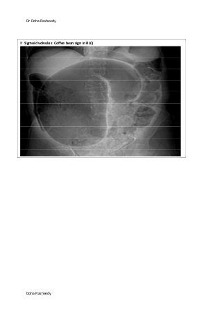 Dr Doha Rasheedy
Doha Rasheedy
Sigmoid volvulus: Coffee bean sign in RLQ
 
