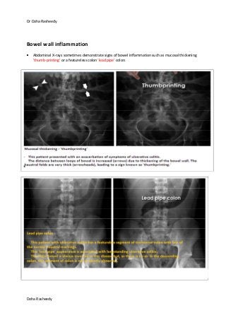 Dr Doha Rasheedy
Doha Rasheedy
Bowel wall inflammation
Abdominal X-rays sometimes demonstrate signs of bowel inflammation such as mucosal thickening
'thumb-printing' or a featureless colon 'lead pipe' colon.
 