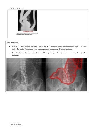 Dr Doha Rasheedy
Doha Rasheedy
Toxic megacolon
The colon is very dilated in this patient with acute abdominal pain, sepsis, and a known history of ulcerative
colitis. The clinical features and X-ray appearances are consistent with toxic megacolon.
There is evidence of bowel wall oedema with 'thumbprinting', and pseudopolyps or 'mucosal islands' (red-
patches).
 