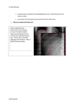 Dr Doha Rasheedy
Doha Rasheedy
o emphysematous cholecystitis (usually gallbladder gas only, ~20% will have gas in the
biliary tree also)
o liver abscess (if contains gas and communicates with the biliary tree)
biliary-bronchopleural fistula (rare)
Supine radiographs often
demonstrate a sword-shaped
lucency in the right paraspinal
region representing gas from the
common duct and the left hepatic
duct. This has been termed the
sabre sign and is present in ~50% of
patients with pneumobilia
 