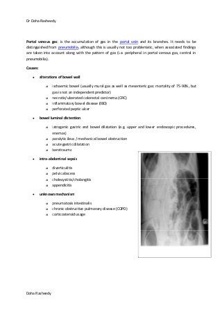Dr Doha Rasheedy
Doha Rasheedy
Portal venous gas: is the accumulation of gas in the portal vein and its branches. It needs to be
distinguished from pneumobilia, although this is usually not too problematic, when associated findings
are taken into account along with the pattern of gas (i.e. peripheral in portal venous gas, central in
pneumobilia).
Causes:
alterations of bowel wall
o ischaemic bowel (usually mural gas as well as mesenteric gas: mortality of 75-90%, but
gas is not an independent predictor)
o necrotic/ulcerated colorectal carcinoma (CRC)
o inflammatory bowel disease (IBD)
o perforated peptic ulcer
bowel luminal distention
o iatrogenic gastric and bowel dilatation (e.g. upper and lower endoscopic procedures,
enemas)
o paralytic ileus / mechanical bowel obstruction
o acute gastric dilatation
o barotrauma
intra-abdominal sepsis
o diverticulitis
o pelvic abscess
o cholecystitis/cholangitis
o appendicitis
unknown mechanism
o pneumatosis intestinalis
o chronic obstructive pulmonary disease (COPD)
o corticosteroid usage
 