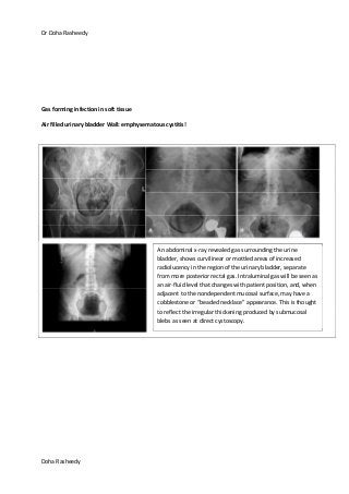 Dr Doha Rasheedy
Doha Rasheedy
Gas forming infection in soft tissue
Air filled urinary bladder Wall: emphysematous cystitis!
An abdominal x-ray revealed gas surrounding the urine
bladder, shows curvilinear or mottled areas of increased
radiolucency in the region of the urinary bladder, separate
from more posterior rectal gas. Intraluminal gas will be seen as
an air-fluid level that changes with patient position, and, when
adjacent to the nondependent mucosal surface, may have a
cobblestone or “beaded necklace” appearance. This is thought
to reflect the irregular thickening produced by submucosal
blebs as seen at direct cystoscopy.
 