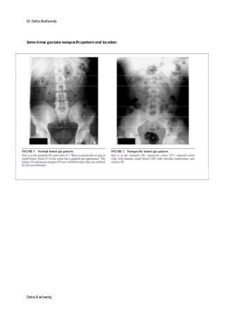 Dr Doha Rasheedy
Doha Rasheedy
Some times gas take nonspecific pattern and location:
 