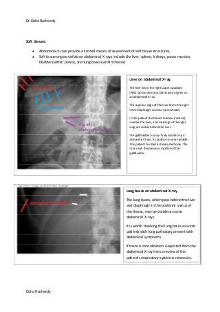 Dr Doha Rasheedy
Doha Rasheedy
Soft tissues:
Abdominal X-rays provide a limited means of assessment of soft tissue structures,
Soft tissue organs visible on abdominal X-rays include the liver, spleen, kidneys, psoas muscles,
bladder (within pelvis), and lung bases (within thorax)
Liver on abdominal X-ray
The liver lies in the right upper quadrant
(RUQ) and is seen as a bland area of grey on
an abdominal X-ray.
The superior edge of the liver forms the right
hemi-diaphragm contour (arrowhead).
In this patient the breast shadow (red line)
overlies the liver, and markings of the right
lung are visible behind the liver.
The gallbladder is only rarely visible on an
abdominal X-ray. Its position is very variable.
This patient has had a cholecystectomy. The
clips mark the previous location of the
gallbladder.
Lung bases on abdominal X-ray
The lung bases, which pass behind the liver
and diaphragm in the posterior sulcus of
the thorax, may be visible on some
abdominal X-rays.
It is worth checking the lung bases as some
patients with lung pathology present with
abdominal symptoms.
If there is consolidation suspected from the
abdominal X-ray then a review of the
patient's respiratory system is necessary.
 