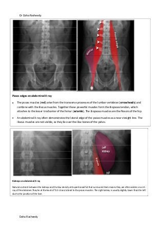 Dr Doha Rasheedy
Doha Rasheedy
Psoas edges on abdominal X-ray
The psoas muscles (red) arise from the transverse processes of the lumbar vertebrae (arrowheads) and
combine with the iliacus muscles. Together these powerful muscles form the iliopsoas tendon, which
attaches to the lesser trochanter of the femur (asterisk). The iliopsoas muscles are the flexors of the hip.
An abdominal X-ray often demonstrates the lateral edge of the psoas muscles as a near straight line. The
iliacus muscles are not visible, as they lie over the iliac bones of the pelvis.
Kidneys on abdominal X-ray
Natural contrast between the kidneys and the low density retroperitoneal fat that surrounds them means they are often visible on an X-
ray of the abdomen.They lie at the level of T12-L3 and lateral to the psoas muscles. The right kidney is usually slightly lower than the left
due to the position of the liver.
 