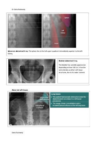 Dr Doha Rasheedy
Doha Rasheedy
Abnormal soft tissues
Spleen on abdominal X-ray: The spleen lies in the left upper quadrant immediately superior to the left
kidney
Bladder abdominal X-ray
The bladder has variable appearance
depending on how full it is. It has the
same density as other soft tissue
structures, due to its water content.
 