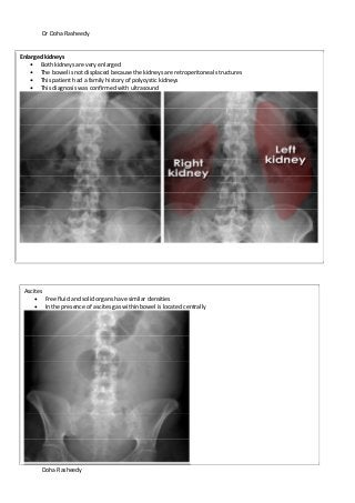 Dr Doha Rasheedy
Doha Rasheedy
Enlarged kidneys
Both kidneys are very enlarged
The bowel is not displaced because the kidneys are retroperitoneal structures
This patient had a family history of polycystic kidneys
This diagnosis was confirmed with ultrasound
Ascites
Free fluid and solid organs have similar densities
In the presence of ascites gas within bowel is located centrally
 
