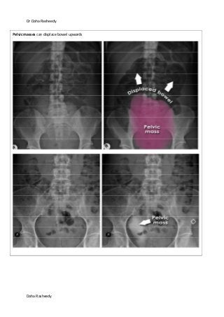 Dr Doha Rasheedy
Doha Rasheedy
Pelvic masses can displace bowel upwards
 