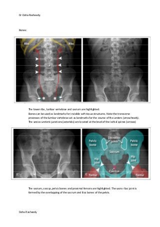 Dr Doha Rasheedy
Doha Rasheedy
Bones:
1.
2.
3.
4.
The lower ribs, lumbar vertebrae and sacrum are highlighted.
Bones can be used as landmarks for invisible soft tissue structures. Note the transverse
processes of the lumbar vertebrae act as landmarks for the course of the ureters (arrowheads).
The vesico-ureteric junctions (asterisks) are located at the level of the ischial spines (arrows)
.
The sacrum, coccyx, pelvic bones and proximal femora are highlighted. The sacro-iliac joint is
formed by the overlapping of the sacrum and iliac bones of the pelvis.
 