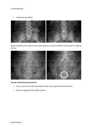 Dr Doha Rasheedy
Doha Rasheedy
4. Calcification and artifact
Ideally all jewellery that overlies anatomically important structures should be removed prior to acquiring
an X-ray
Vascular calcification and ring pessary
If seen, vascular (aorto-iliac) calcification implies a more generalised atherosclerosis.
Note the ring pessary in this elderly patient.
 