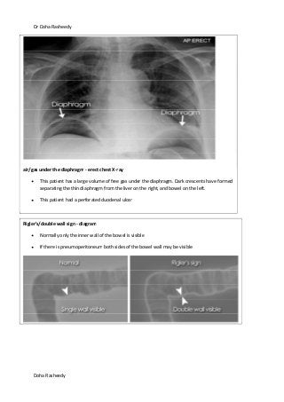 Dr Doha Rasheedy
Doha Rasheedy
air/gas under the diaphragm - erect chest X-ray
This patient has a large volume of free gas under the diaphragm. Dark crescents have formed
separating the thin diaphragm from the liver on the right, and bowel on the left.
This patient had a perforated duodenal ulcer
Rigler's/double wall sign - diagram
Normally only the inner wall of the bowel is visible
If there is pneumoperitoneum both sides of the bowel wall may be visible
 
