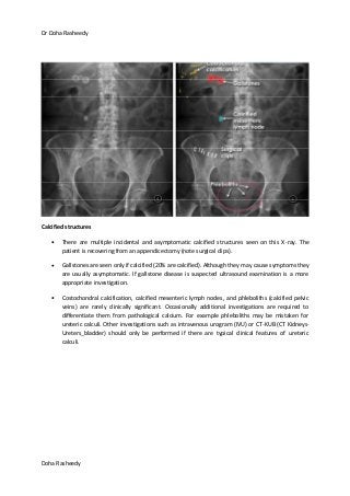 Dr Doha Rasheedy
Doha Rasheedy
Calcified structures
There are multiple incidental and asymptomatic calcified structures seen on this X-ray. The
patient is recovering from an appendicectomy (note surgical clips).
Gallstones are seen only if calcified (20% are calcified). Although they may cause symptoms they
are usually asymptomatic. If gallstone disease is suspected ultrasound examination is a more
appropriate investigation.
Costochondral calcification, calcified mesenteric lymph nodes, and phleboliths (calcified pelvic
veins) are rarely clinically significant. Occasionally additional investigations are required to
differentiate them from pathological calcium. For example phleboliths may be mistaken for
ureteric calculi. Other investigations such as intravenous urogram (IVU) or CT-KUB (CT Kidneys-
Ureters_bladder) should only be performed if there are typical clinical features of ureteric
calculi.
 