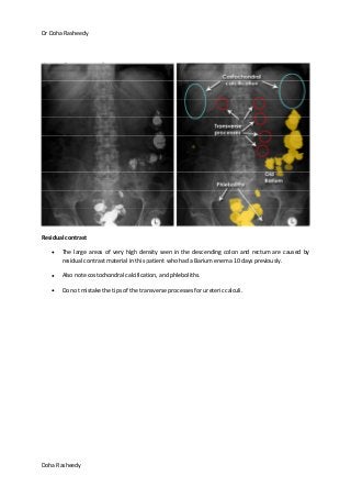 Dr Doha Rasheedy
Doha Rasheedy
Residual contrast
The large areas of very high density seen in the descending colon and rectum are caused by
residual contrast material in this patient who had a Barium enema 10 days previously.
Also note costochondral calcification, and phleboliths.
Do not mistake the tips of the transverse processes for ureteric calculi.
 