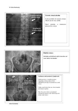 Dr Doha Rasheedy
Doha Rasheedy
Ureteric stone/calculus
Look carefully for ureteric stones
which can be very subtle
Don't mistake a transverse
process for a stone
Bladder stones
Multiple well defined calcific densities are
seen within the bladder
Gallstones and mesenteric lymph node
Gallstones have a variable position
depending on the position of the
gallbladder and may be mistaken for renal
stones
Unlike renal stones they are often rounded
and cluster together
This X-ray also shows an incidental
calcified mesenteric node which may also
mimic renal stones
 