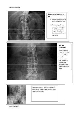 Dr Doha Rasheedy
Doha Rasheedy
Abdominal aortic aneurysm -
AAA
There is calcification of
the dilated aortic wall
Frequently only one
side of the aneurysm
is visible - as in this
image - the other
being projected over
the spine
Vascular
calcification
There is striking
calcification of the
aorta and iliac
vessels
This is a sign of
generalised
atherosclerosis
elsewhere in the
body
Appendicoliths are highly predictive of
appendicitis in patients presenting with
right iliac fossa pain
 