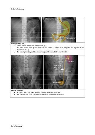 Dr Doha Rasheedy
Doha Rasheedy
Naso-jejunal tube
Placed for the purpose of enteral feeding
The tube passes through the stomach and forms a C-shape as it navigates the 4 parts of the
duodenum (D1-4)
The tube tip lies beyond the duodenojejunal flexure which lies on the left
Pig-tail (JJ) stent
A ureteric stent has been placed to relieve ureteric obstruction
The catheter has loops (pig-tails) at both ends which hold it in place
 