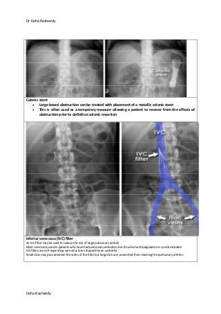 Dr Doha Rasheedy
Doha Rasheedy
Colonic stent
Large bowel obstruction can be treated with placement of a metallic colonic stent
This is often used as a temporary measure allowing a patient to recover from the effects of
obstruction prior to definitive colonic resection
Inferior vena cava (IVC) filter
An IVC filter may be used to reduce the risk of large pulmonary emboli
Most commonly used in patients who have had pulmonary embolism but for whom anticoagulation is contraindicated
IVC filters are self-expanding wire structures shaped like an umbrella
Small clots may pass between the wires of the filter but large clots are prevented from reaching the pulmonary arteries
 
