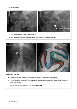 Dr Doha Rasheedy
Doha Rasheedy
The double wall sign (Rigler's sign) is visible
Gas separates bowel segments and forms sharp angles and triangles (asterisks)
football sign - example
2 radiographs were required to completely cover the abdomen in this large patient
A large volume of free gas has risen to the front of the peritoneal cavity resulting in a large round black
area - 'football sign'
The double wall sign (Rigler's) is also visible (arrowhead)
 