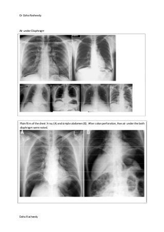 Dr Doha Rasheedy
Doha Rasheedy
Air under Diaphragm
Plain film of the chest X-ray (A) and simple abdomen (B). After colon perforation, free air under the both
diaphragm were noted.
 