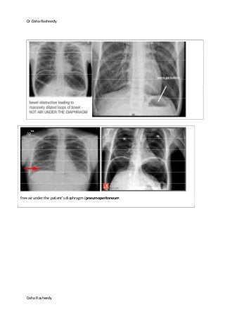 Dr Doha Rasheedy
Doha Rasheedy
free air under the patient’s diaphragm (pneumoperitoneum
 