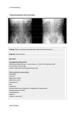 Dr Doha Rasheedy
Doha Rasheedy
Thumb printing (bowel wall inflammation)
Findings: Mild to moderate bowel edematous walls of the tranverse colon.
Diagnosis: Crohn's Disease
Discussion:
Thumbprinting of Bowel DDx:
Inflammatory Bowel Disease - most common. i.e. Crohn's and Ulcerative Colitis
Diverticulosis or Diverticulitis
Ischemic Colitis with hemorrhage into bowel wall
Other Uncommon causes include:
Amyloidosis
Carcinoid
Angineurotic Edema
CMV colitis in AIDS
Endometriosis
HUS
Lymphoma
Parasitic Infections esp Amebiasis, Strongyloides, Schistosomiasis
Pseudomembranous Colitis
Toxic Megacolon
Typhlitis
Urticaria "colon hives"
 