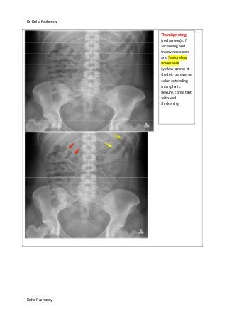 Dr Doha Rasheedy
Doha Rasheedy
Thumbprinting
(red arrows) of
ascending and
transverse colon
and featureless
bowel wall
(yellow arrow) at
the left transverse
colon extending
into splenic
flexure, consistent
with wall
thickening.
 
