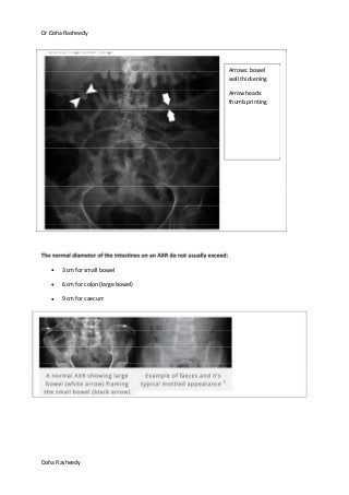 Dr Doha Rasheedy
Doha Rasheedy
The normal diameter of the intestines on an AXR do not usually exceed:
3 cm for small bowel
6 cm for colon (large bowel)
9 cm for caecum
Arrows: bowel
wall thickening
Arrow heads:
thumb printing
 