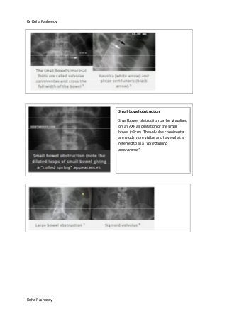 Dr Doha Rasheedy
Doha Rasheedy
Small bowel obstruction
Small bowel obstruction can be visualised
on an AXR as dilatation of the small
bowel (>3cm). The valvulae conniventes
are much more visible and have what is
referred to as a “coiled spring
appearance”.
 