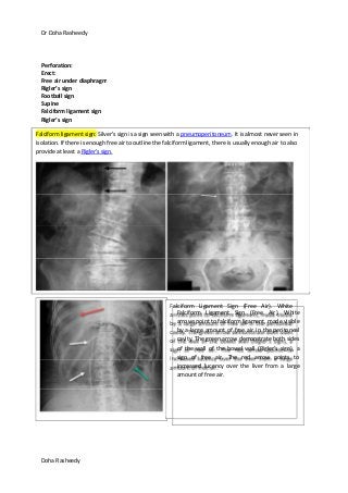 Dr Doha Rasheedy
Doha Rasheedy
Perforation:
Erect:
Free air under diaphragm
Rigler’s sign
Football sign
Supine
Falciform ligament sign
Rigler’s sign
Falciform ligament sign: Silver's sign is a sign seen with a pneumoperitoneum. It is almost never seen in
isolation. If there is enough free air to outline the falciform ligament, there is usually enough air to also
provide at least a Rigler's sign.
Falciform Ligament Sign (Free Air). White
arrows point to falciform ligament, made visible
by a large amount of free air in the peritoneal
cavity. The green arrow demonstrate both sides
of the wall of the bowel wall (Rigler's sign), a
sign of free air. The red arrow points to
increased lucency over the liver from a large
amount of free air.
Falciform Ligament Sign (Free Air). White
arrows point to falciform ligament, made visible
by a large amount of free air in the peritoneal
cavity. The green arrow demonstrate both sides
of the wall of the bowel wall (Rigler's sign), a
sign of free air. The red arrow points to
increased lucency over the liver from a large
amount of free air.
 