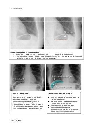 Dr Doha Rasheedy
Doha Rasheedy
Normal stomach bubble - erect chest X-ray
Round/ovoid - 'bubble' shape Thick upper wall Fluid level or food contents
In contrast to this, free intra-abdominal gas forms a crescent under the diaphragm, and is separated
from the lungs only by the thin membrane of the diaphragm
Chilaiditi's phenomenon
In patients who have small livers (cirrhosis),
or flattened diaphragms due to lung
hyperexpansion (emphysema), a void is
created within the upper abdomen above the
liver. This space may be filled by bowel. If this
bowel is air filled then it may mimic free gas
Chilaiditi's phenomenon - example
Gas forms a near crescent shape under the
right hemidiaphragm
There is however a thick hemidiaphragm
(partly consisting of bowel wall)
Gas can be seen to lie within bowel
Importantly, this patient with
hyperexpanded lungs, due to emphysema,
did not have acute abdominal pain
 