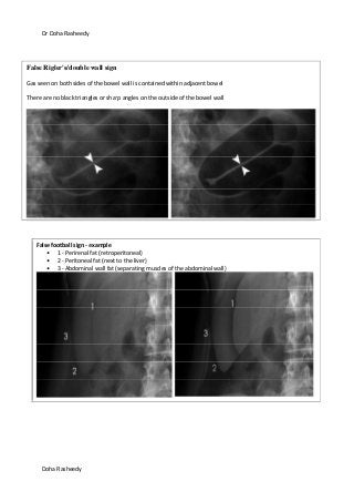 Dr Doha Rasheedy
Doha Rasheedy
False Rigler's/double wall sign
Gas seen on both sides of the bowel wall is contained within adjacent bowel
There are no black triangles or sharp angles on the outside of the bowel wall
False football sign - example
1 - Perirenal fat (retroperitoneal)
2 - Peritoneal fat (next to the liver)
3 - Abdominal wall fat (separating muscles of the abdominal wall)
 