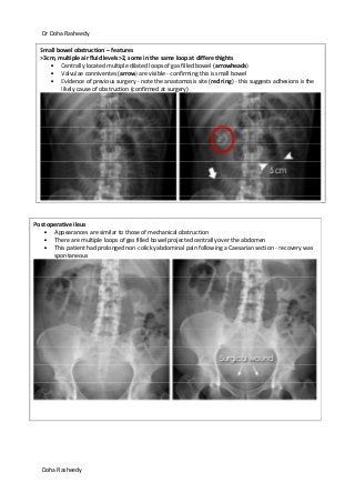Dr Doha Rasheedy
Doha Rasheedy
Small bowel obstruction – features
>3cm, multiple air fluid levels>2, some in the same loop at differe thights
Centrally located multiple dilated loops of gas filled bowel (arrowheads)
Valvulae conniventes (arrow) are visible - confirming this is small bowel
Evidence of previous surgery - note the anastomosis site (red ring) - this suggests adhesions is the
likely cause of obstruction (confirmed at surgery)
Post operative ileus
Appearances are similar to those of mechanical obstruction
There are multiple loops of gas filled bowel projected centrally over the abdomen
This patient had prolonged non-colicky abdominal pain following a Caesarian section - recovery was
spontaneous
 